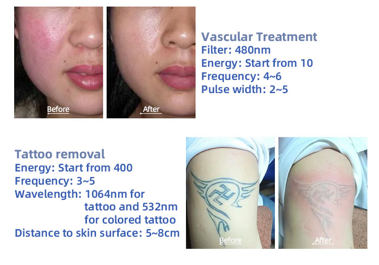 Hair Remover Laser Machine Factory hair removal and tatoo removal machine (13)
