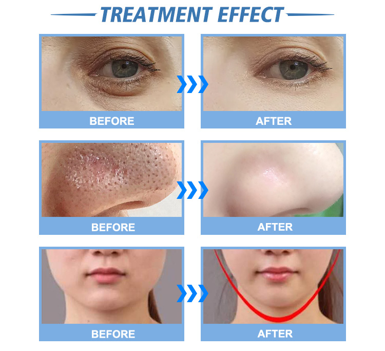 d oxygeneo machine newest hydrafacial machine (8)