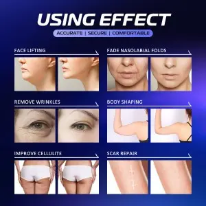 Portable HIFU Machine: Your On – the – Go Beauty Solution