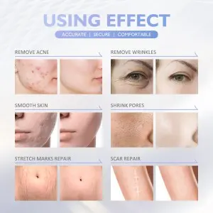 RF – Microneedle Beauty Device: Transform Your Skin