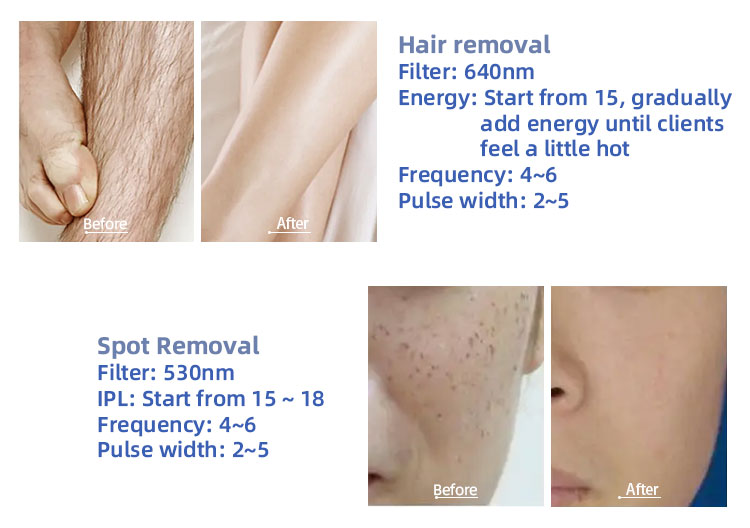 Hair Remover Laser Machine Factory hair removal and tatoo removal machine (11)